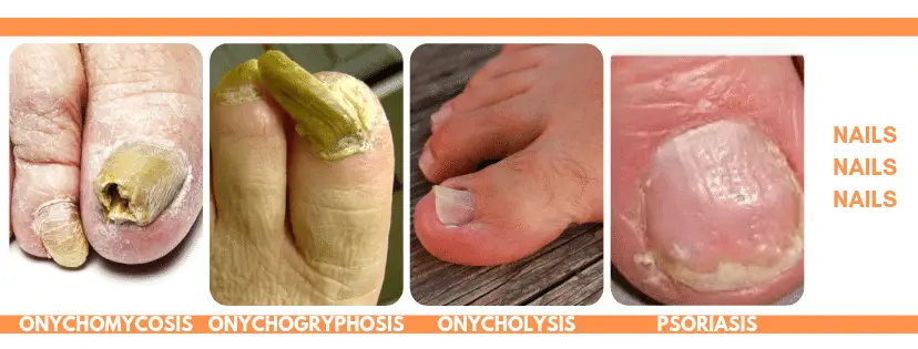 is this fungal toenail