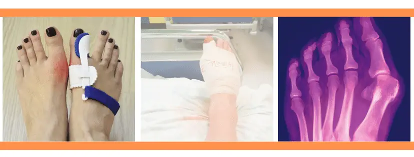 bunion photo and bunion splint and a bunion surgery image all in one