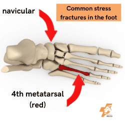 common stress fracture in the foot location are the 4th metatarsal and the navicular bone image and text