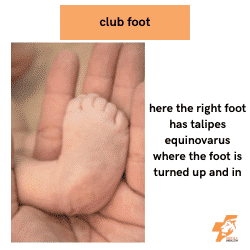 club foot or talipes equinovarus image and explanation from australian podiatrist