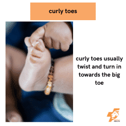 curly toes usually turn in towards the big toe