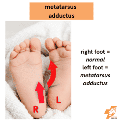 metatarsus adductus image compared to a normal foot
