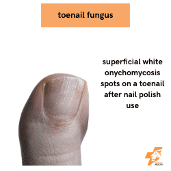 superficial white onychomycosis toenail fungus