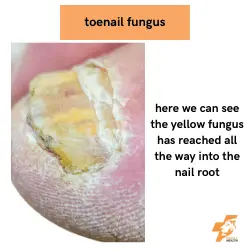 toenail fungus into the nail root