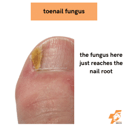 toenail fungus on the side of the toe