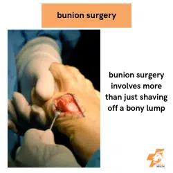 a bunion surgery being performed
