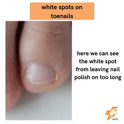 leaving nail polish on too long causes white spots on your toenails