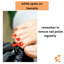 if you dont remove your nail polish it can be a cause of white spots on your toenails