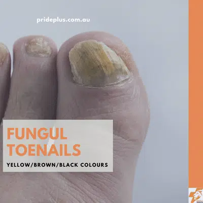 toenail fungus can be the reason you have a black toenail