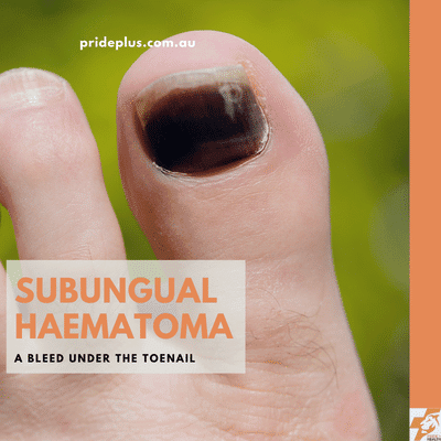 a bleed under the toenail called a subungual haematoma is why this toenail is black