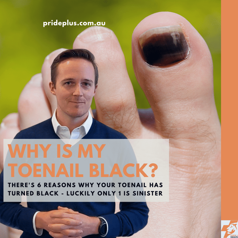 6 Reasons Why You Have A Black Toenail According To Podiatrists