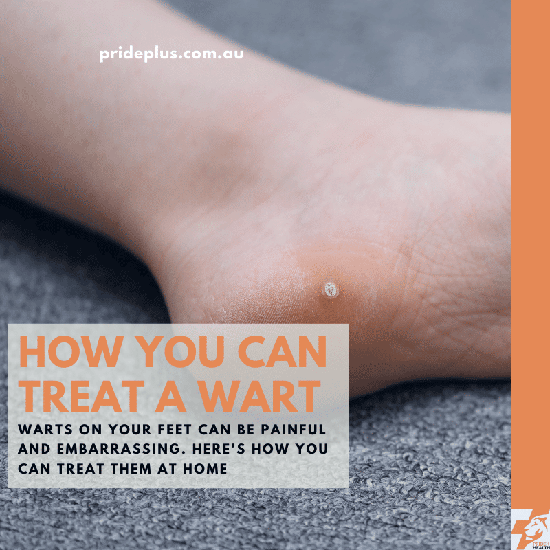 a blog post from a podiatrist how to get rid of warts on your feet at home
