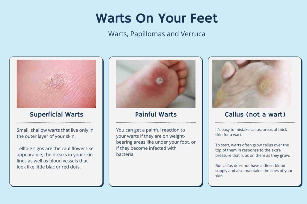 What Is The Difference Between A Foot Corn And A Plantar Wart 