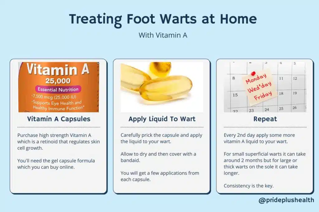 podiatrist advice how to treat warts on your feet at home with vitamin A