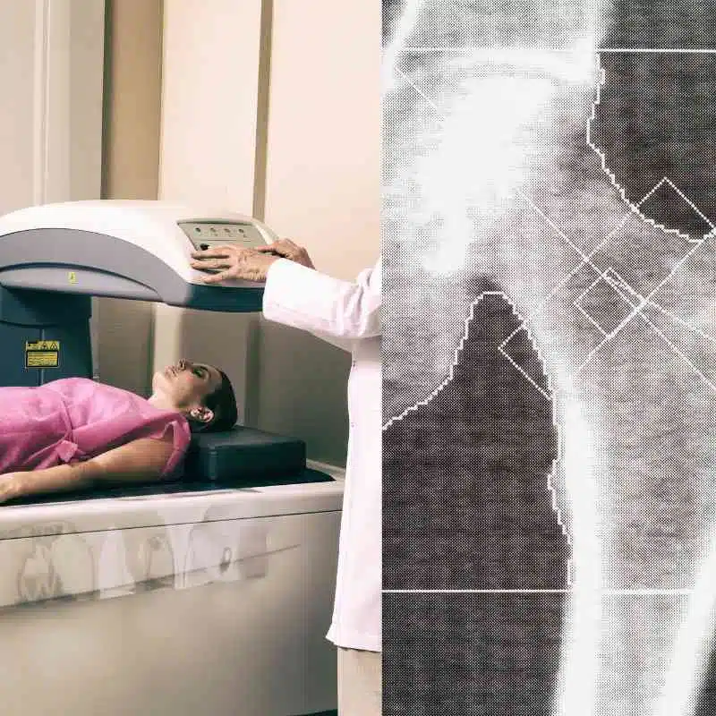 dexa bone density scan and femur t score result