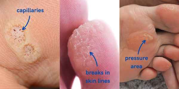 three images showing the difference between a foot corn and a plantar wart