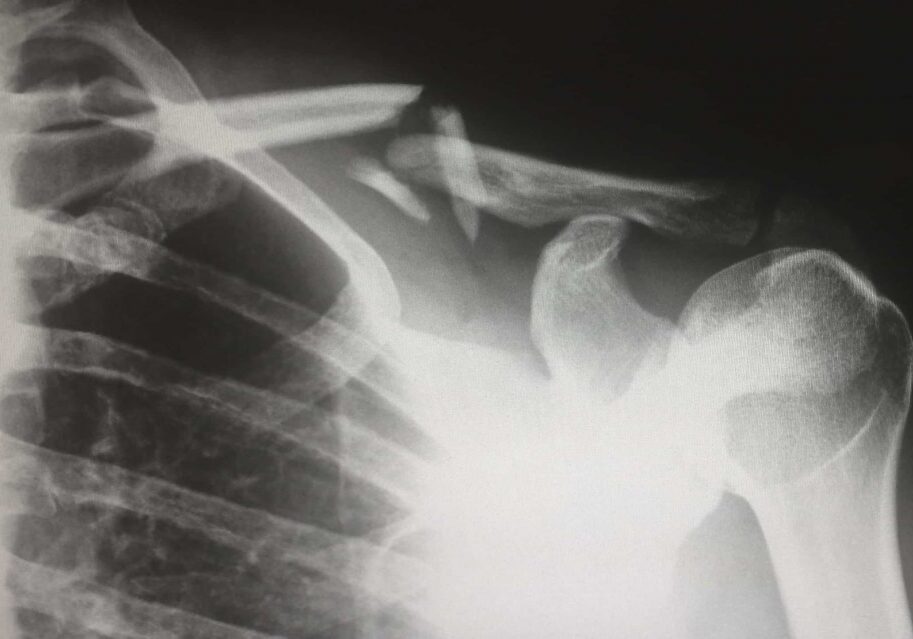shoulder pain x ray